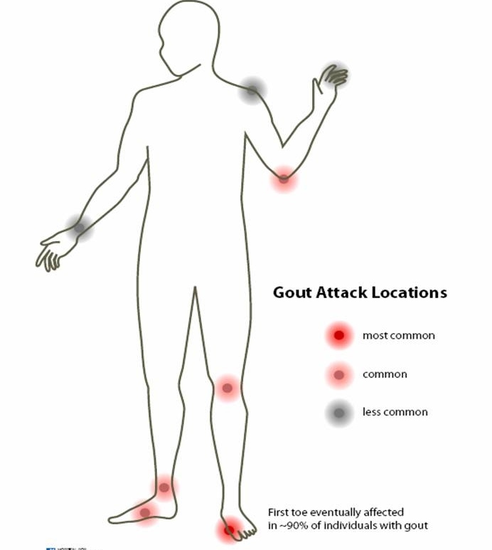 Gout Uric Acid Homeopathic Treatment